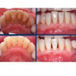 Bouche malade présentant du tartre (Haut) et bouche saine après détartrage et polissage des dents (Bas)