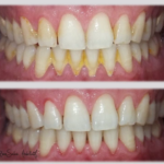 Bouche malade présentant du tartre (Haut) et bouche saine après détartrage et polissage des dents (Bas)