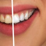 Dents avec coloration à droite et dent après blanchiment à gauche