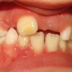 Dyschromie dentaire