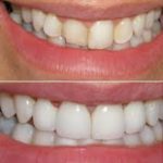 avant et après pose de facettes dentaires