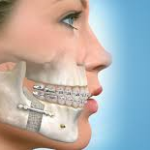 Fracture de la mâchoire inférieure ou mandibule
