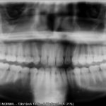 Radio panoramique dents incluses et enclavées (avant traitement)